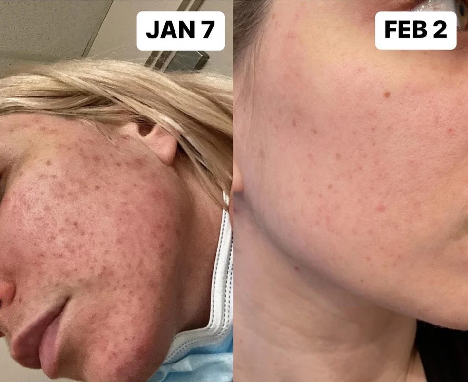 fotos de antes e depois pele com acne fúngica
