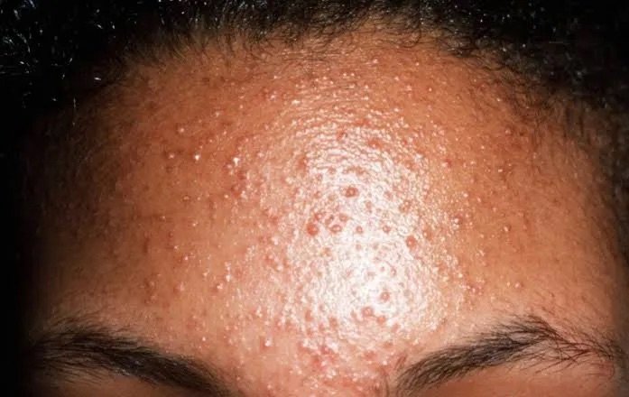 acne fúngica na testa