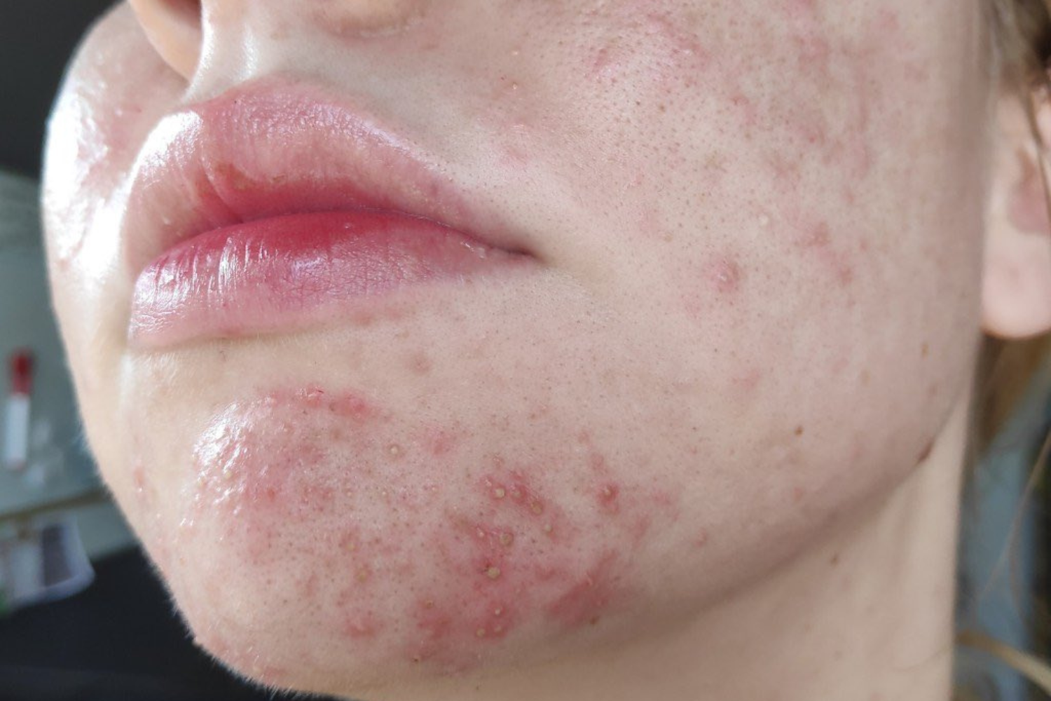 pele com acne fúngica exemplo